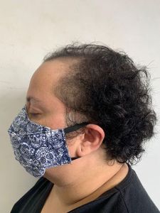 Juiz de Fora/MG - TRANSPLANTE CAPILAR DA JUNIA ALMEIDA