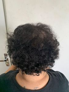 Transplante Capilar Junia Almeida - TRANSPLANTE CAPILAR DA JUNIA ALMEIDA