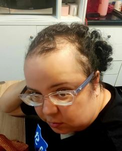 TRANSPLANTE CAPILAR DA JUNIA ALMEIDA imagem 7