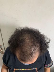 Saúde e Emergências - TRANSPLANTE CAPILAR DA JUNIA ALMEIDA