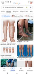 Saúde e Emergências - Uma amiga com LINFEDEMA precisa meias compressão 