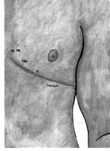 null - A vaquinha do Ben - Mamoplastia Masculinizadora