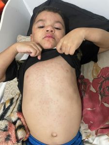 Calebinho - Ajude A Comprar O Medicamento Para O Caleb