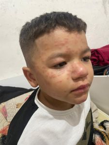 Vaquinha Online - Ajude A Comprar O Medicamento Para O Caleb