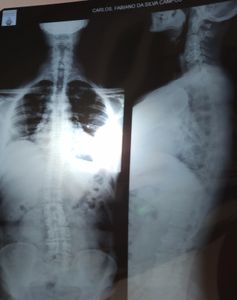 Vaquinha Online - Ajude Fabiano Campos portador de Espondilite Anquilosante 