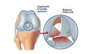 Vaquinha Online - Cirurgia para o ligamento do joelho