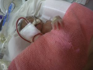 Saúde e Emergências - Minha Bebê nasceu de 22 semanas com 444 gramas