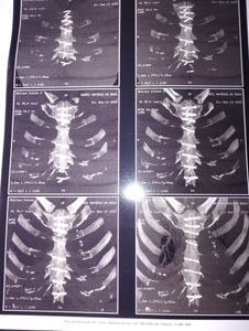 Vaquinha Online - Ajuda a recuperar minha visão e sequelas de 2 Infartos 