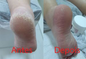 Saúde e Emergências - Curso plástica dos pés funcionar?Quais os beneficios dos curso plásticas dos pés? Sabia tudos sobre o curso plástica dos pés 