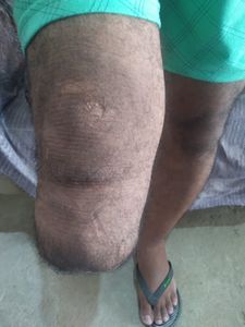 Paulista/PE - Me ajude a conseguir minha prótese