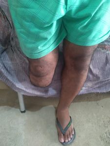 Me ajude a conseguir minha prótese - Me ajude a conseguir minha prótese