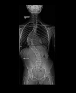 Vaquinha Online - Ajude Juan a corrigir sua grave escoliose para crescer saudável!!!