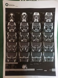 Vaquinha Online - Recadar dinheiro para pagar a anestesia da minha cirurgia dos seios da face
