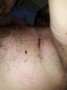 Ajuda Cirurgia hidradenite supurativa  - ajuda para Cirurgia Hidradenite supurativa