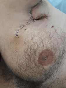 Vaquinha Online - ajuda para Cirurgia Hidradenite supurativa