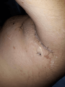 Saúde e Emergências - ajuda para Cirurgia Hidradenite supurativa