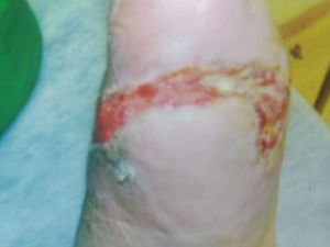 cirugia do pé - CIRUGIA PARA TIRAR A TALA DO DEDÃO DO PÉ