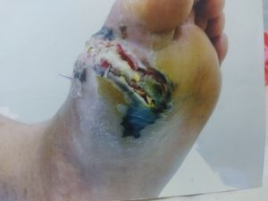 Vaquinha Online - CIRUGIA PARA TIRAR A TALA DO DEDÃO DO PÉ