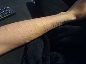 Vaquinha Online - Tatoo para tirar cicatriz do braço