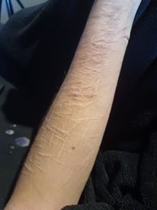 Eventos do Bem - Tatoo para tirar cicatriz do braço