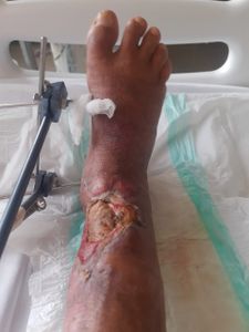 Arteriografia - Antônio Teixeira  imagem 10