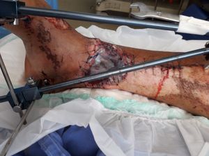 Valparaíso de Goiás/GO - Arteriografia - Antônio Teixeira 