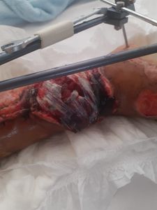 Arteriografia - Antônio Teixeira  imagem 6