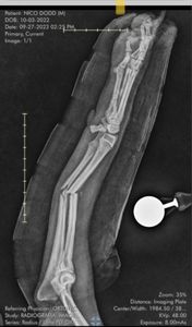 Ajude Nico a pagar a cirugia que além de ter salvado sua vida e a voltar a andar - Ajude a pagar a cirurgia de reconstrução de fratura e tratamento de infecção do Nico