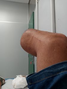 Ajudar o Odair a Comprar uma Prótese Transtibial imagem 7