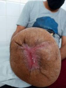 Saúde e Emergências - Ajudar o Odair a Comprar uma Prótese Transtibial