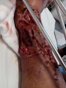 Ajudar o Odair a Comprar uma Prótese Transtibial imagem 10