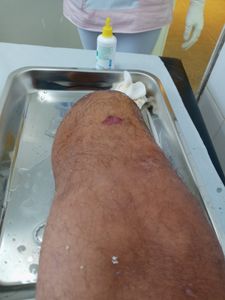 Ajudar o Odair a Comprar uma Prótese Transtibial imagem 8