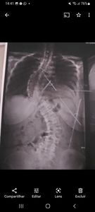 Vaquinha Online - Tratamento para voltar a andar