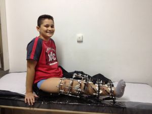 TRATAMENTO PARA HEMIMELIA FIBULAR BILATERAL