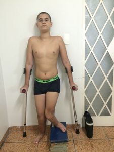TRATAMENTO PARA HEMIMELIA FIBULAR BILATERAL