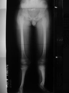 ME AJUDE COM MEU TRATAMENTO PARA HEMIMELIA FIBULAR BILATERAL - TRATAMENTO PARA HEMIMELIA FIBULAR BILATERAL