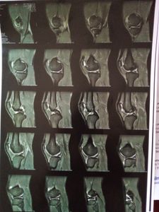 Vaquinha Online - Fundos pra tratamento artroscópico