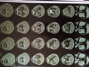 Gilnei - cirurgia de joelho - Fundos pra tratamento artroscópico