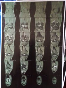 Crowdfunding - Fundos pra tratamento artroscópico