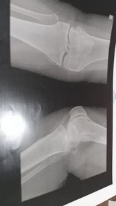 Saúde e Emergências - Cirurgia do joelho da Eliane 