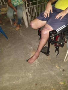 Vaquinha Online - Adiquirir Handbike para exercitar o corpo e a mente.