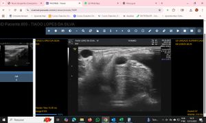 Cirurgia do braço do atleta  Tiago Silva