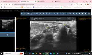 Cirurgia do braço do atleta  Tiago Silva