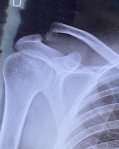 Ajude Lucas no tratamento da clavícula