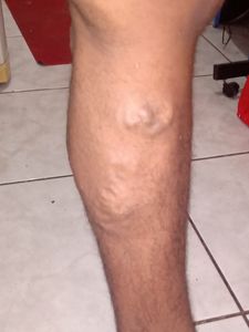 Vaquinha Online - Cirurgia urgente de Renan Graciano