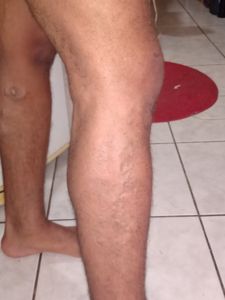 Rio de Janeiro/RJ - Cirurgia urgente de Renan Graciano