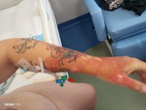 Me ajudem com os custos do tratamento do meu acidente e com meus filhos!!!!