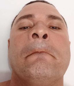 Vaquinha Online - Cirurgia para retirada de cisto nasolabial