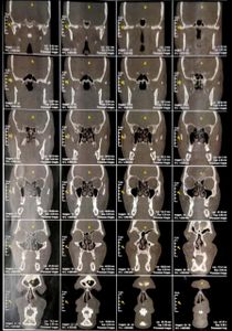 REGINALDO DE OLIVEIRA - Cirurgia para retirada de cisto nasolabial