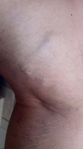 Vaquinha Online - Me ajude a fazer cirugia vascular minhas varises Sao in